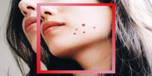 Read more about the article How Should Acne Treatments Be Working Good?
