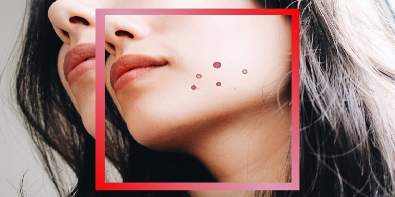 Acne Clearing Treatments