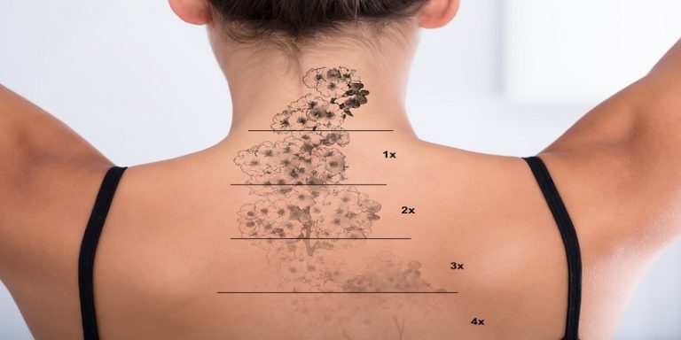 NYC laser tattoo lightening