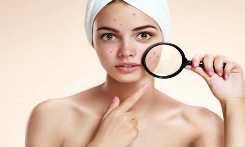 How to Get Rid of Acne?