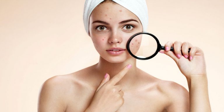 How to Get Rid of Acne