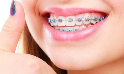 Is Invisalign Faster Than Braces?