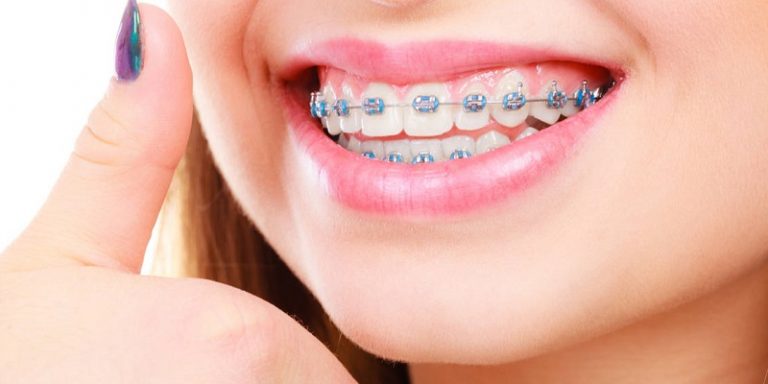 Is Invisalign Faster Than Braces
