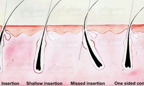 How Does Thermolysis Destroy Hair Follicles?