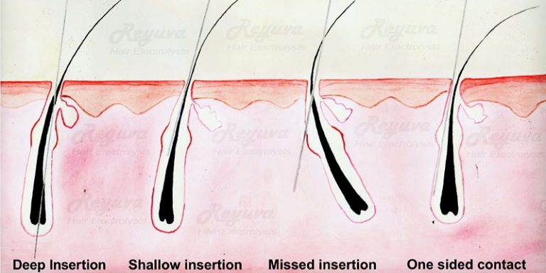 How Does Thermolysis Destroy Hair Follicles