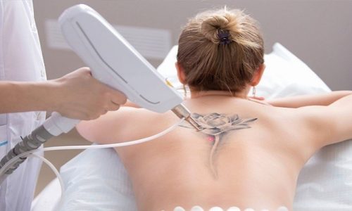 Can You Get Laser Hair Removal Over A Tattoo?