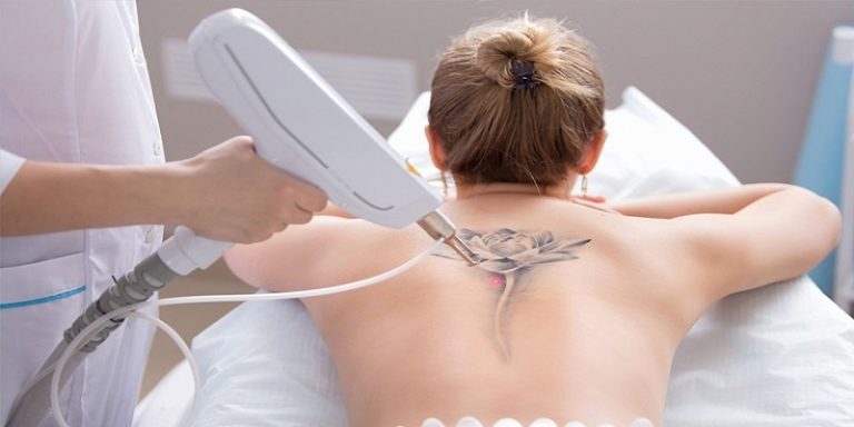Can You Get Laser Hair Removal Over A Tattoo