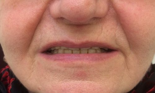 How To Get Lip Support From Dentures?