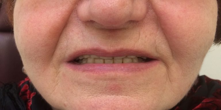 How To Get Lip Support From Dentures