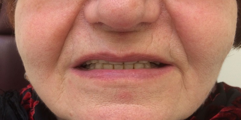 You are currently viewing How To Get Lip Support From Dentures?