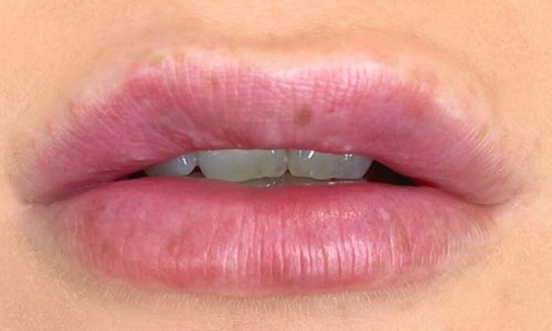 How To Prevent Cold Sores After Lip Fillers?