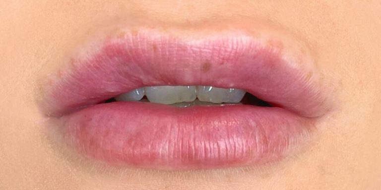 How To Prevent Cold Sores After Lip Fillers