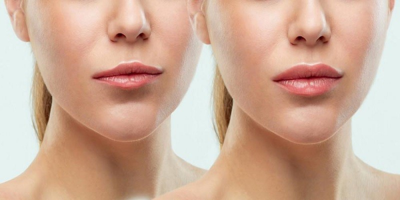 How To Reduce Swelling After Lip Fillers?