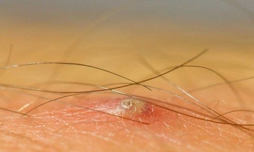 How To Tell If It’S An Ingrown Hair Or Herpes?