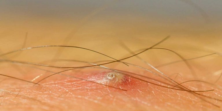 How To Tell If It'S An Ingrown Hair Or Herpes