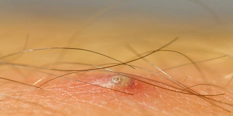 You are currently viewing How To Tell If It’S An Ingrown Hair Or Herpes?