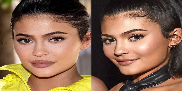 How To Tell If Someone Has Lip Fillers
