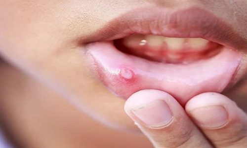 How To Treat A Swollen Lip After Dental Work?