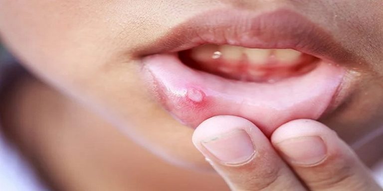 How To Treat A Swollen Lip After Dental Work