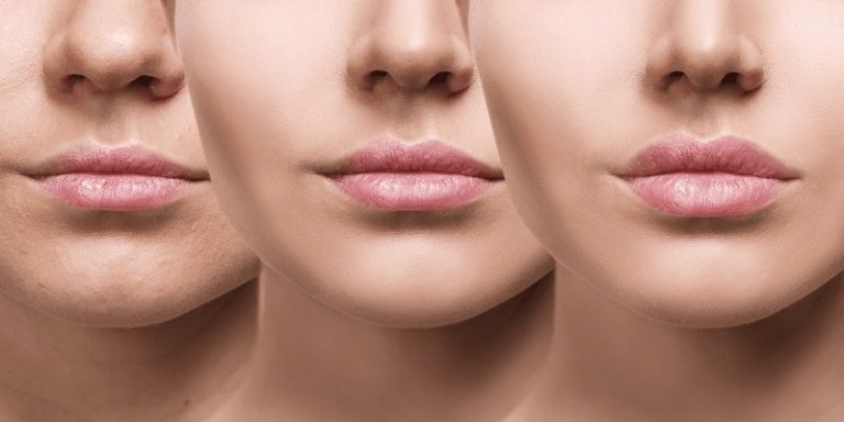 How Long Does Lip Injections Last