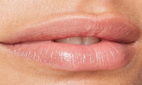 How Long To Lip Fillers Last?