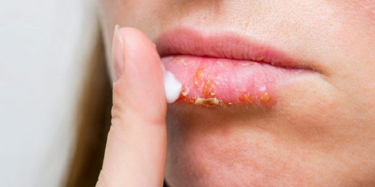 How To Get Rid Of Bruised Lips From Kissing