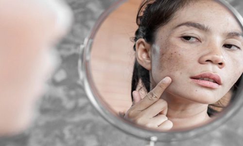 How To Hide Dark Spots On Your Face Without Makeup?