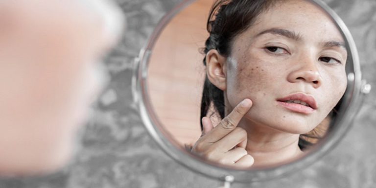 How To Hide Dark Spots On Your Face Without Makeup