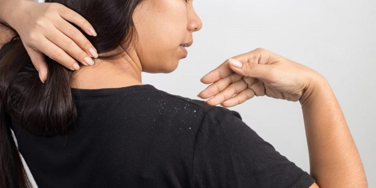 Dandruff Vs. Dry Scalp