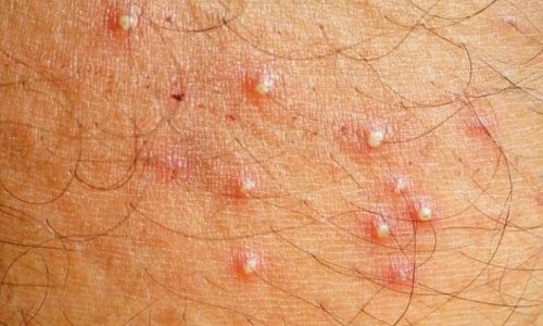 Can Hair Grow Out Of Herpes Bumps?