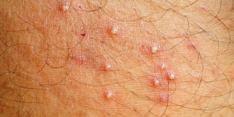 Can Hair Grow Out Of Herpes Bumps