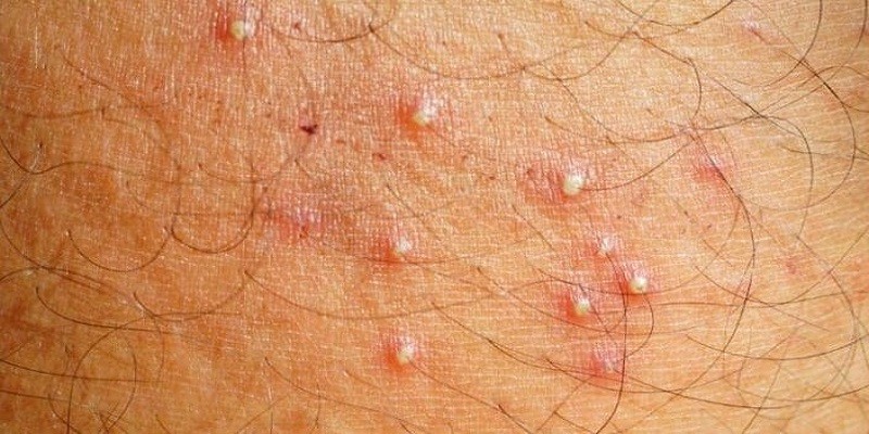 Can Hair Grow Out Of Herpes Bumps?