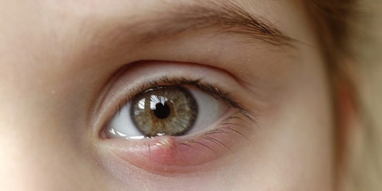 Can I Wear Makeup With A Stye