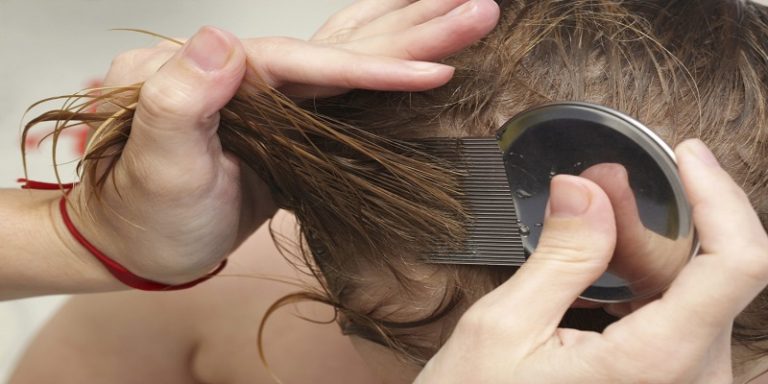 Can Lice Cause Hair Loss