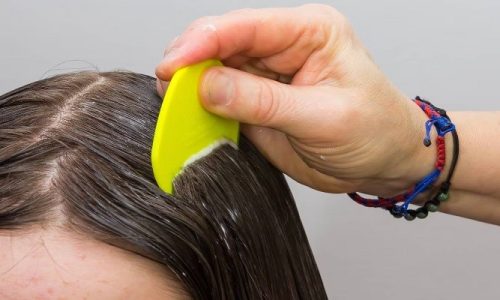 Can Lice Make Your Hair Fall Out?