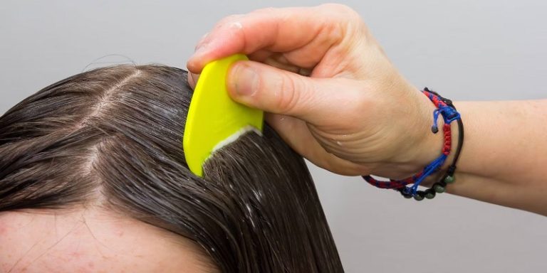 Can Lice Make Your Hair Fall Out