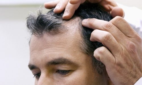 Can Syphilis Make You Lose Your Hair?