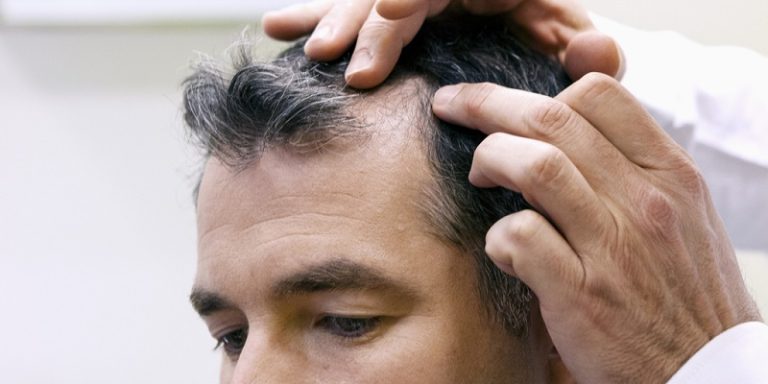 Can Syphilis Make You Lose Your Hair