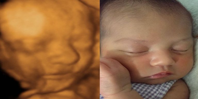 Can You See Hair On 3D Ultrasound