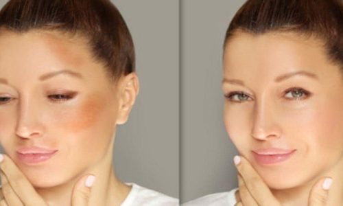 How To Cover Melasma With Makeup?