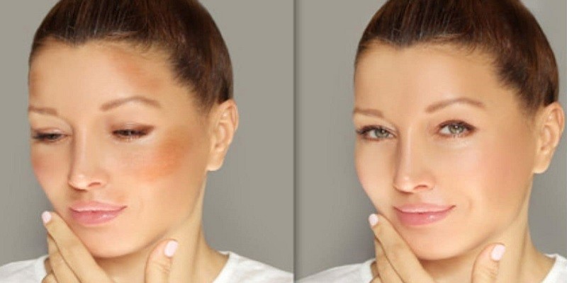 How To Cover Melasma With Makeup