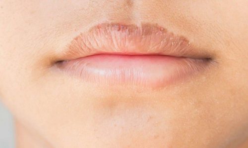 How To Get Rid Of Smokers Lips?