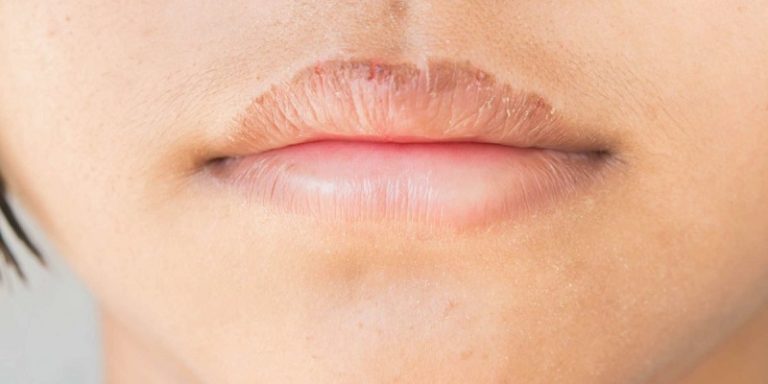 How To Get Rid Of Smokers Lips
