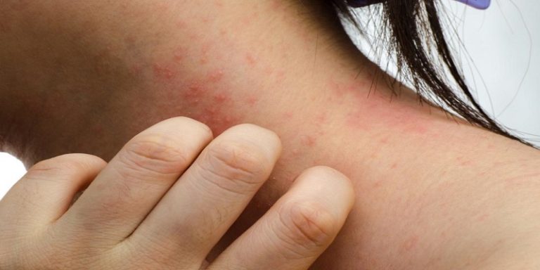 How To Know If You'Re Allergic To Synthetic Hair