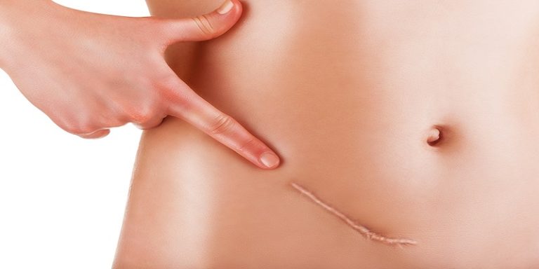 How To Get Rid Of Lipo Scars