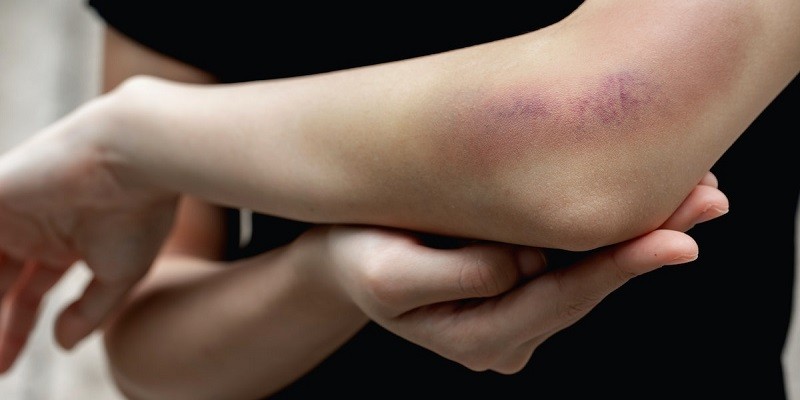 How To Hide A Bruise Without Makeup