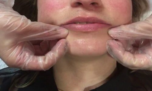 How To Massage Lips After Filler?