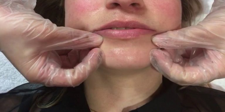 How To Massage Lips After Filler