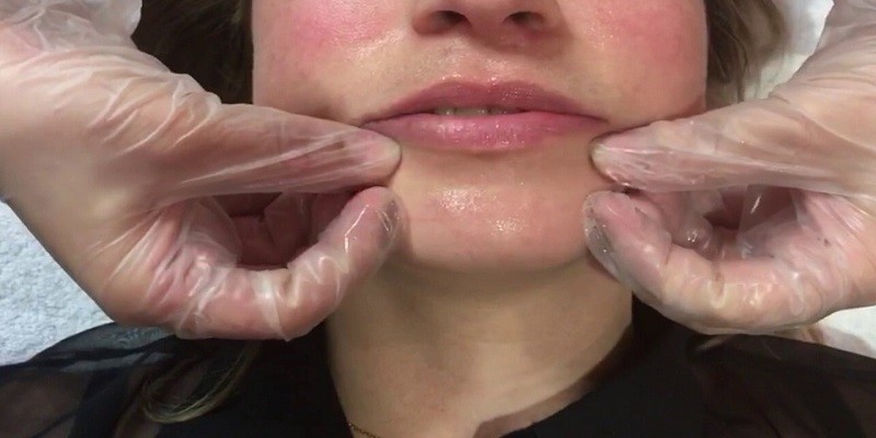 You are currently viewing How To Massage Lips After Filler?