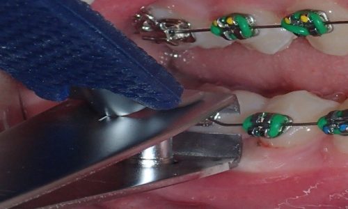 How to Cut Braces Wire Easily Using Nail Clippers?